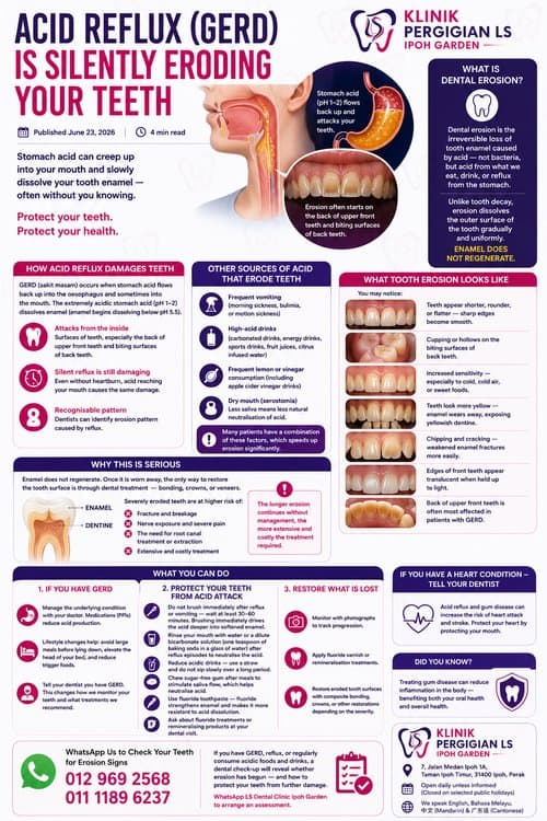 Acid Reflux (GERD) Is Silently Eroding Your Teeth