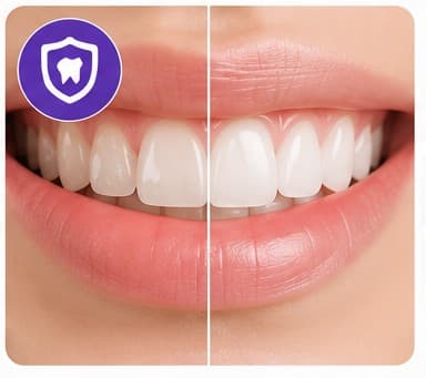 DMG ICON Fluorosis