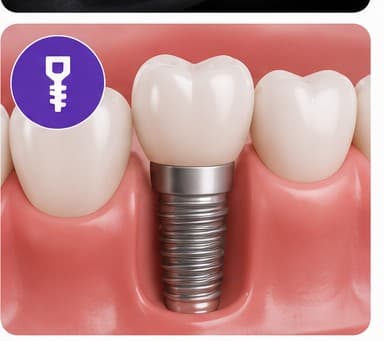 Dental Implant